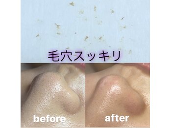ビューティーネイル(Beauty Nail)/毛穴エクストラクション