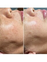 ルーチェエムベルシック(Luce.MBelChic)/スノーピール★