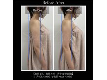 パルファンドゥー(parfum doux)/痩身【背中】ビフォーアフター