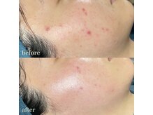 ちらちゅら/クリスティーナ【施術経過】