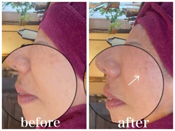 ルー ハナレ 神戸岡本 摂津本山店(Luu HANARE)/小顔シミ・シワ・たるみ改善