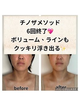 ルース(LUCE)/頬下のボリューム・むくみ解消