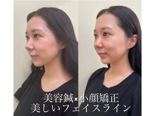鍛冶町鍼灸整骨院/美容鍼灸初心者におすすめ◎小顔
