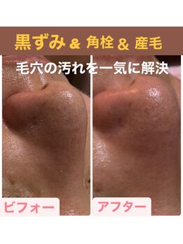 シエルグロウ(CielGrow)/毛穴除去