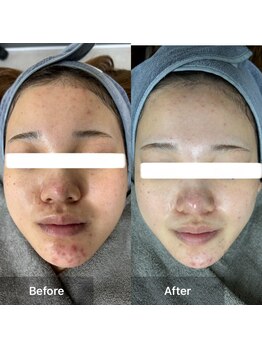 モカ 天王寺店(MOKA)/剥離ハーブピーリングニキビケア