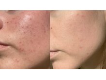 フェリーチェ(FELICE)の雰囲気（ニキビ集中ケアのお客様でニキビができにくいお肌になりました）