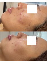 aura.まつげ・ハーブピーリング専門店/7回での変化