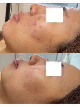 aura.まつげ・ハーブピーリング専門店/7回での変化