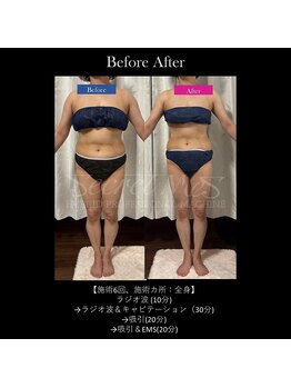 フルオール(FRUOR)の写真/落ちにくい脂肪を燃焼◎本気の痩身ケア