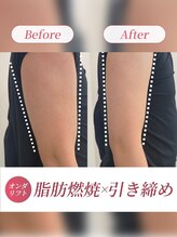 リフト 梅田(Lift)&nbsp;ハミ肉改善 引き締め