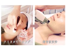 エッセンスエナジーの雰囲気（シミケアマシンの前に、ピーリングで余分な角質をオフします）