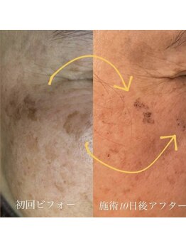 ラエッセ 恵比寿(LAESSE)/毛穴・美白専門店 LAESSE 恵比寿