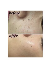 フォルチェ ゆめタウン広島店(Folche)/ヒト幹細胞フェイシャル