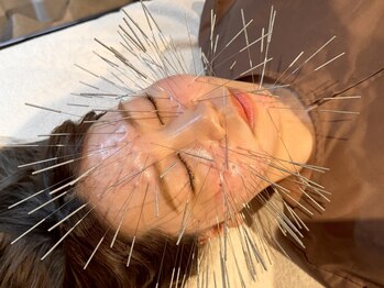 ジーニー(genie)の写真/《歴10年以上》本気でなりたい自分を目指す覚悟を決めた方限定！鬼ルート美容鍼を受けるならココ◎