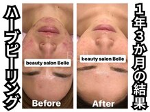 ベル 心斎橋店(Belle)/ハーブピーリング