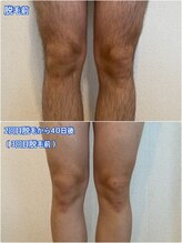 リノ沼津(Lino)/足脱毛　2回終了後40日経過