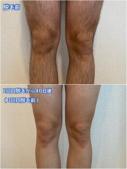 リノ沼津(Lino)/足脱毛　2回終了後40日経過