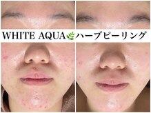 アワピール 天王寺店(AWA PEELL)/ハーブピーリング/ニキビケア