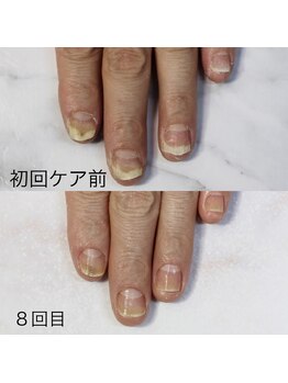 アイネイルズ(Ai nails)/形改善【ネイルケアコース】