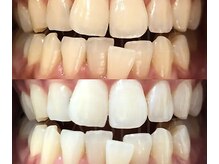 ライトケアサロン 表参道店(Light Care Salon)/セルフホワイトニング