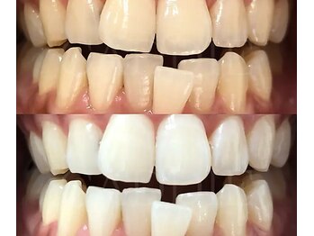 ライトケアサロン 表参道店(Light Care Salon)/セルフホワイトニング