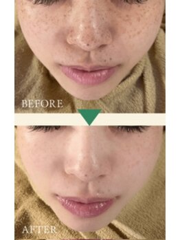 シャルム(CHARMER)/幹細胞入りハーブピーリング