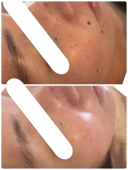 エルール トータルビューティ(Aileure total beauty)/くすみ、シミケア