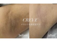 クレーヴ(CREVE)/韓国最先端技術