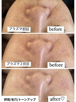 ミラビューティー(Mira Beauty)/シミくすみ/トーンアップ