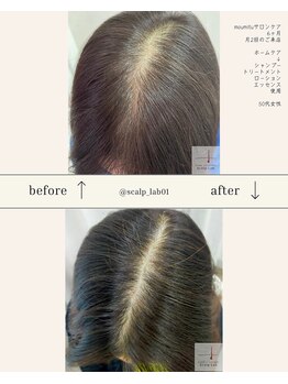 スカルプラボ 倉敷店(Scalp Lab)/moumitu症例6ヶ月