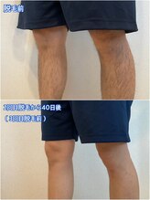 リノ沼津(Lino)/足脱毛２回終了後40日経過