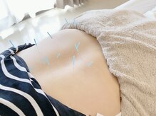 鍼灸サロン 道/鍼灸