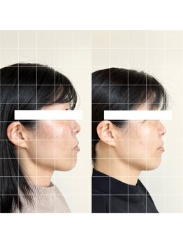 ファソ ブロウアンドアイズ(fasol)/小顔コース6回