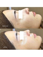 アーネスト 大阪心斎橋店(EARNEST)/水光ピーリング【 赤み・過敏 】