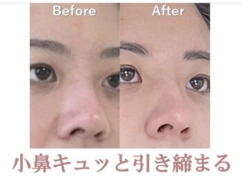 ラプリエイル 千葉店(Raplit aile)/ 隆鼻+輪郭矯正40分10回