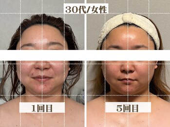 コガオラボ 甲府店(KOGAO LABO)/お客様☆Before&After☆