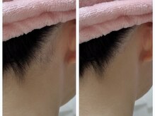 GRACETHOUSAND(グレイスサウザンド)/うなじ脱毛/セルフ脱毛