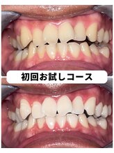 ホワイトニングビューティー 吉祥寺店/ホワイトニング　初来店