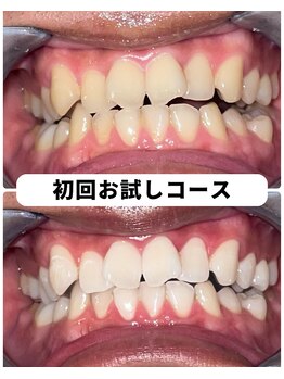 ホワイトニングビューティー 吉祥寺店/ホワイトニング 初来店