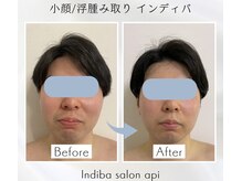 アピ(api)/症例写真【むくみインディバ】