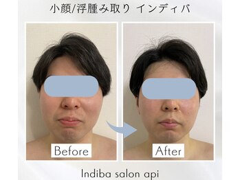 アピ(api)/症例写真【むくみインディバ】