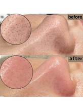 ティティビュティ 一宮駅前店(TTBeauty)/日本一受賞のエクストラクション