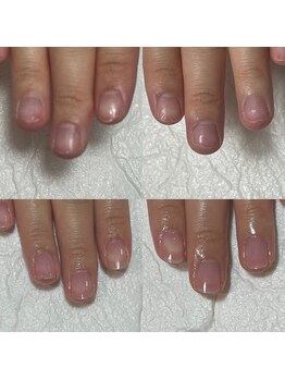 セラキュアネイル(Theracure nail)/アセトンオフで傷んだ爪の育成