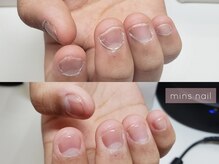 ミンスネイル(Mins Nail)/深爪ケアbefore&after