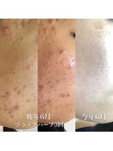 アネラ(ANELA)/エルモサハーブ症例.5