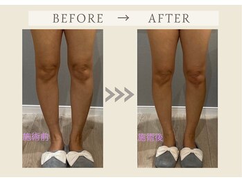 フェリチタトウキョウ(Felicita Tokyo)/インディバBeforeAfter_脚