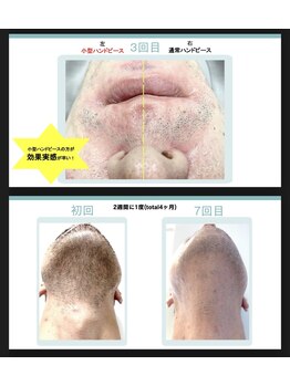 ペルレ(Perle)/ひげ　症例写真　1