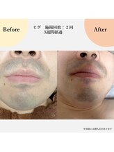 スリール(sourire)/ヒゲ脱毛