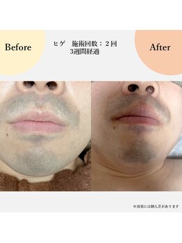 スリール(sourire)/ヒゲ脱毛