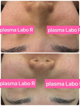 アール(R)/プラズマオキシバブルピーリング